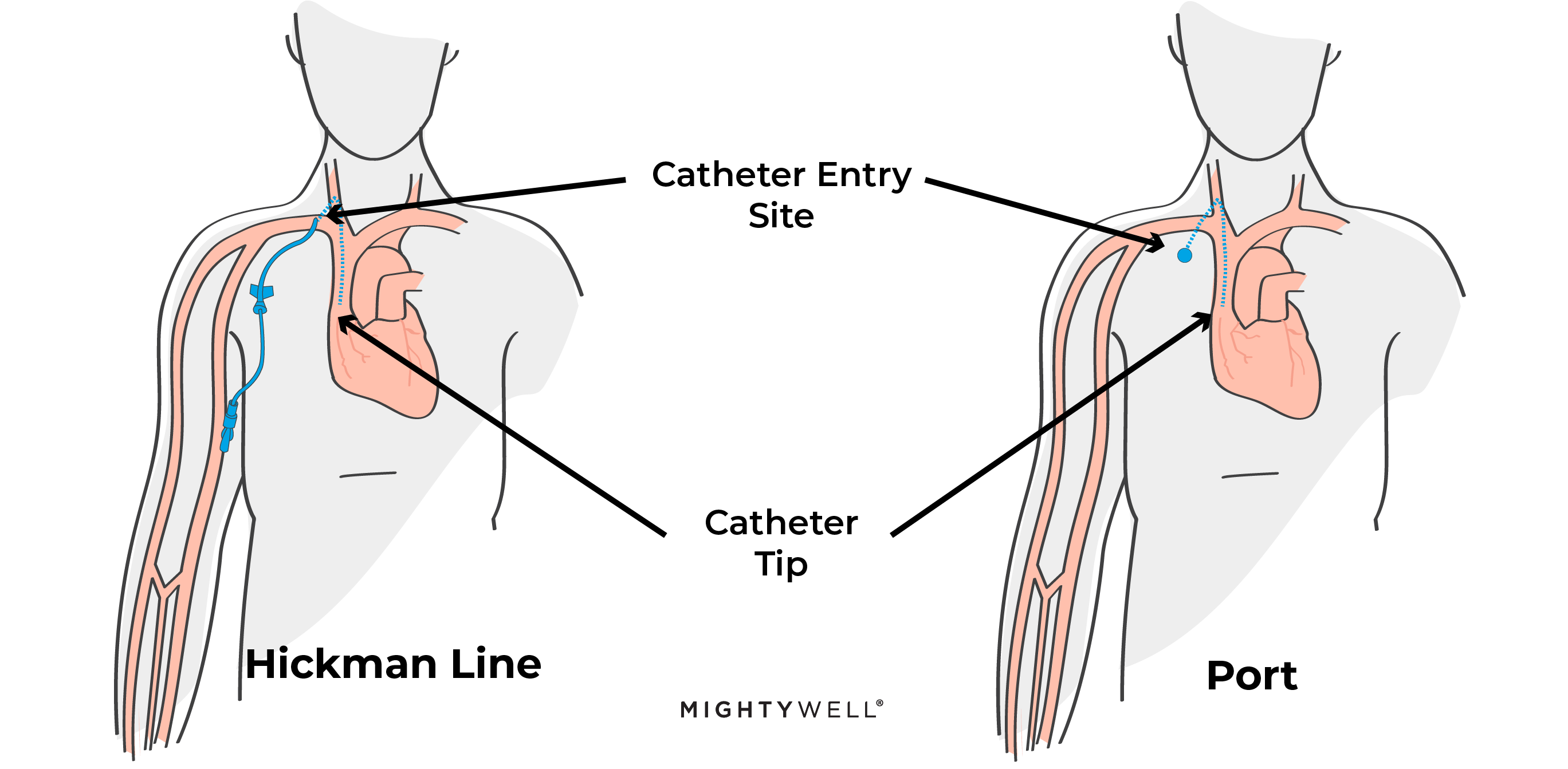 Hickman Line vs. Ports: What's the Difference? Mighty Well Hickman Line vs. Ports: What's the Difference? Mighty Well