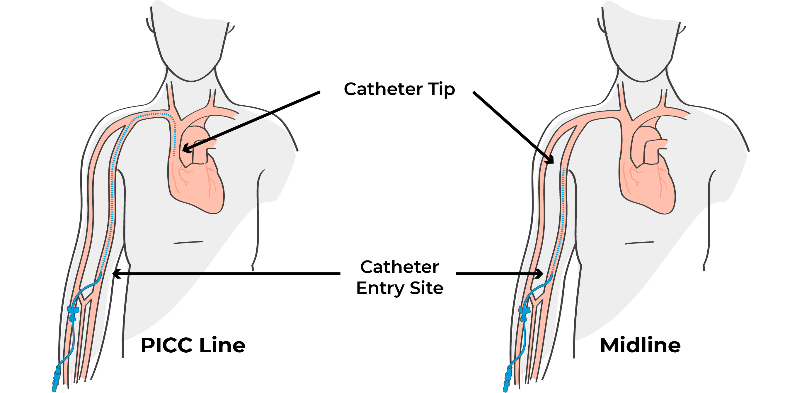 PICC Lines And Midlines Breaking Down The Differences Mighty Well picc-lines-and-midlines-breaking-down-the-differences-mighty-well