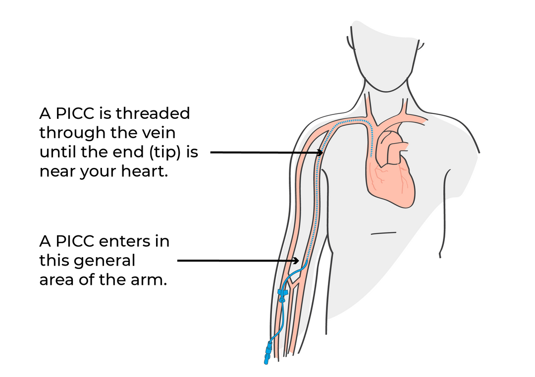 PICC Line, PICC, PICC lines explained, what is a PICC Line?